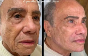 Ator Stenio Garcia, de 91 anos, compartilha resultado de harmonização facial